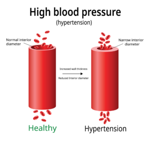 Image showing the comparison between a health artery vs. a hypertension artery 